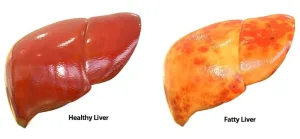 Breakthrough Research Unveils Potential Drug Treatment for Fatty Liver Disease Using Stem Cells