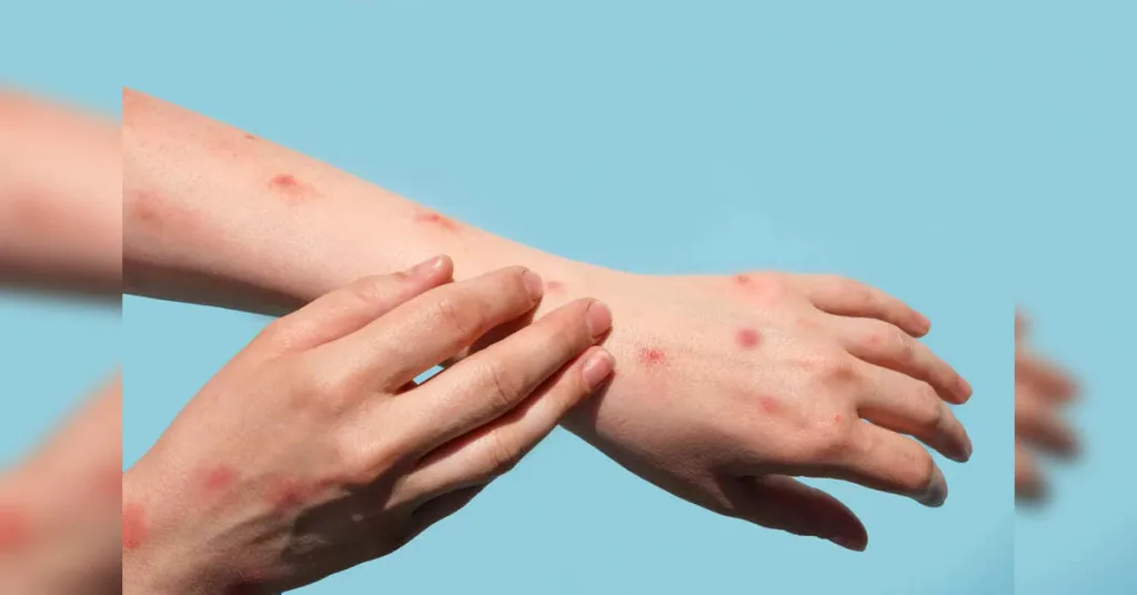 Mpox Cases Rising in Pakistan: Health Authorities on Alert