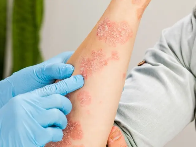 Doctor Warns of Summer-Related Skin and Stomach Ailments